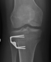 Post Osteochondral Allograft